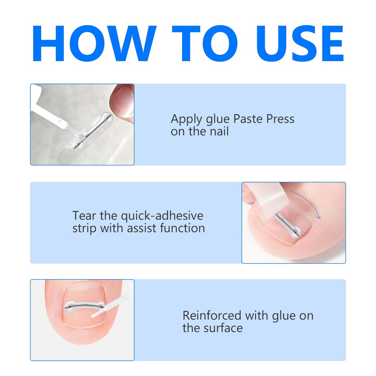 Ingrown Toenail Treatment, Toenail Correction Strips for Curved or Ingrown Nails, Ingrown Toe Nail Relief Remover Strips, Quick Relief, Nail Correction, 5 Different Sizes