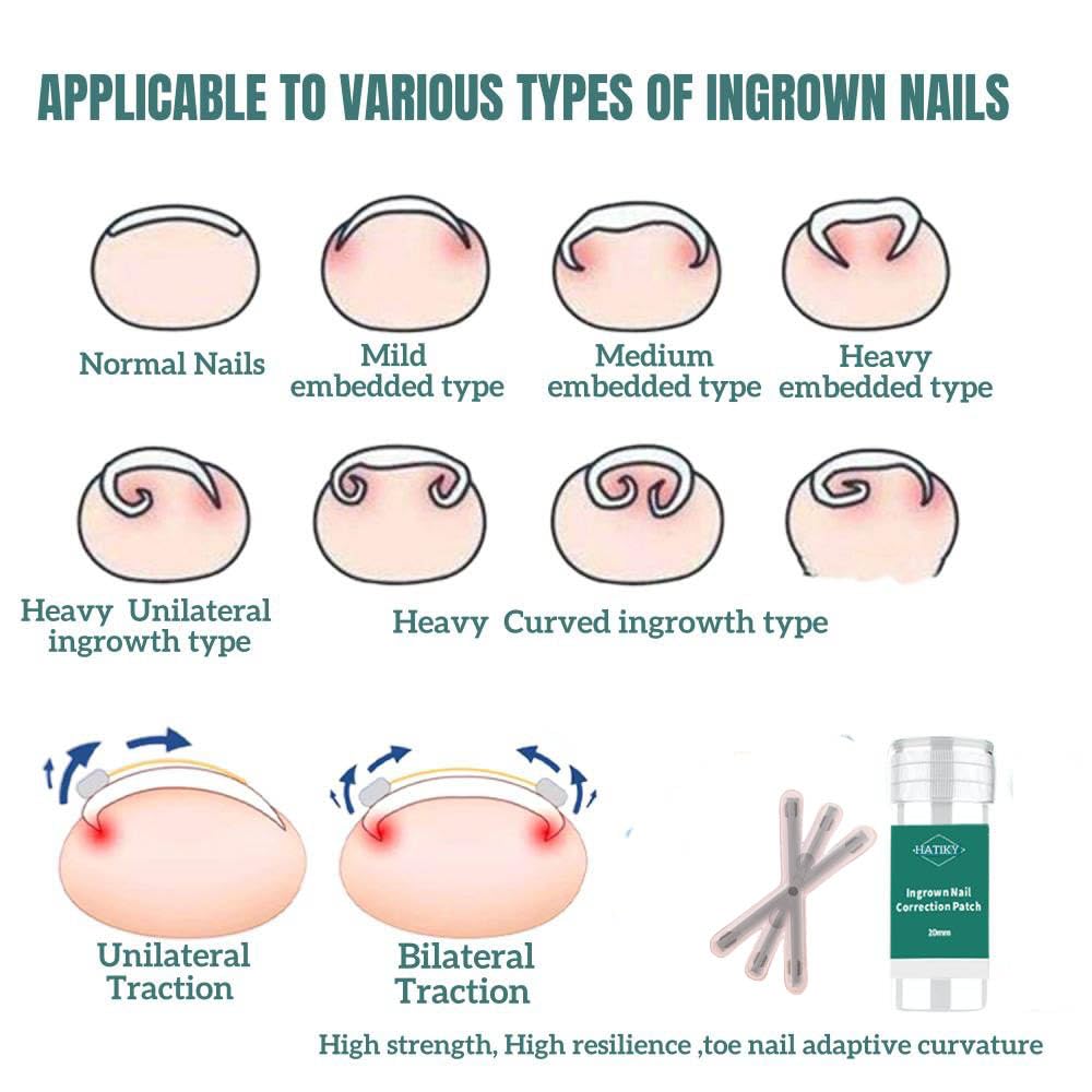 Ingrown Toenail Treatment & Removal Kit (New 6X Tension) at Home Treatment for Toenails,Titanium Alloy Ingrown Toenail Corrector, Nail Tools for Curved Nail Repair for Men Woman (0.67/0.79in)