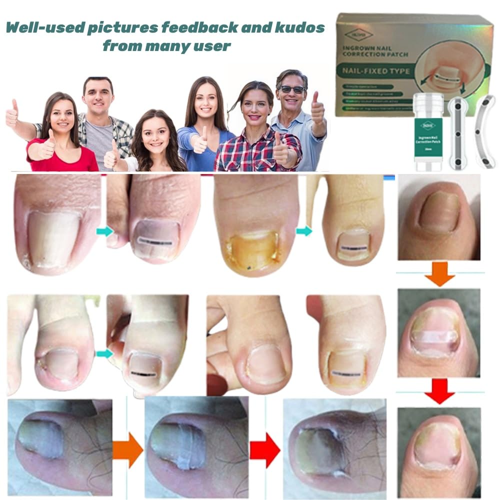 Ingrown Toenail Treatment & Removal Kit - at Home Treatment for Ingrown Toenails, Titanium Alloy Ingrown Toenail Corrector, Nail Tools for Curved Nail Repair Suitable for Men Woman (((0.67/0.79in)))