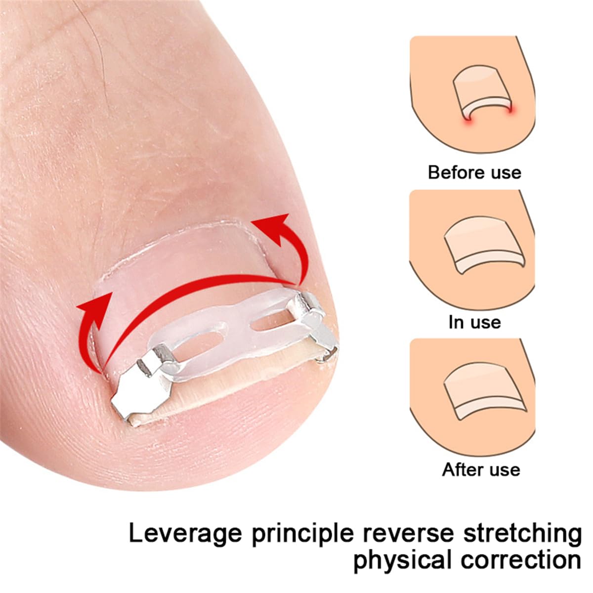 Ingrown Toenail Correction Tool Set, 2 Stainless Steel Insert Clips Ingrown Toenail Treatment Elastic Silicone Strips Ingrowns Nail Corrector Patch Pedicure Tool Removal Kit for Curved Toe Nail Repair
