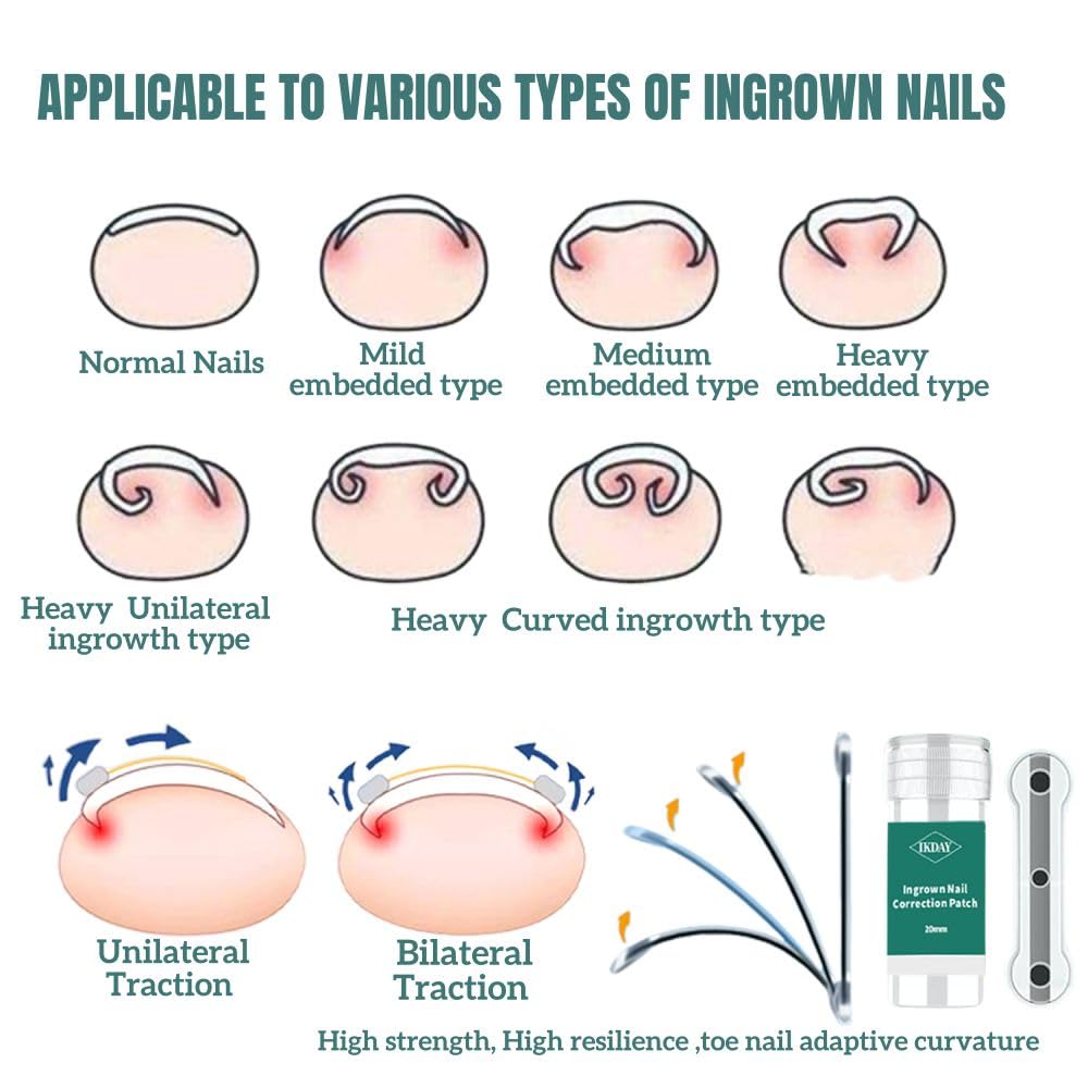 Ingrown Toenail Treatment & Removal Kit - at Home Treatment for Ingrown Toenails, Titanium Alloy Ingrown Toenail Corrector, Nail Tools for Curved Nail Repair Suitable for Men Woman (((0.67/0.79in)))