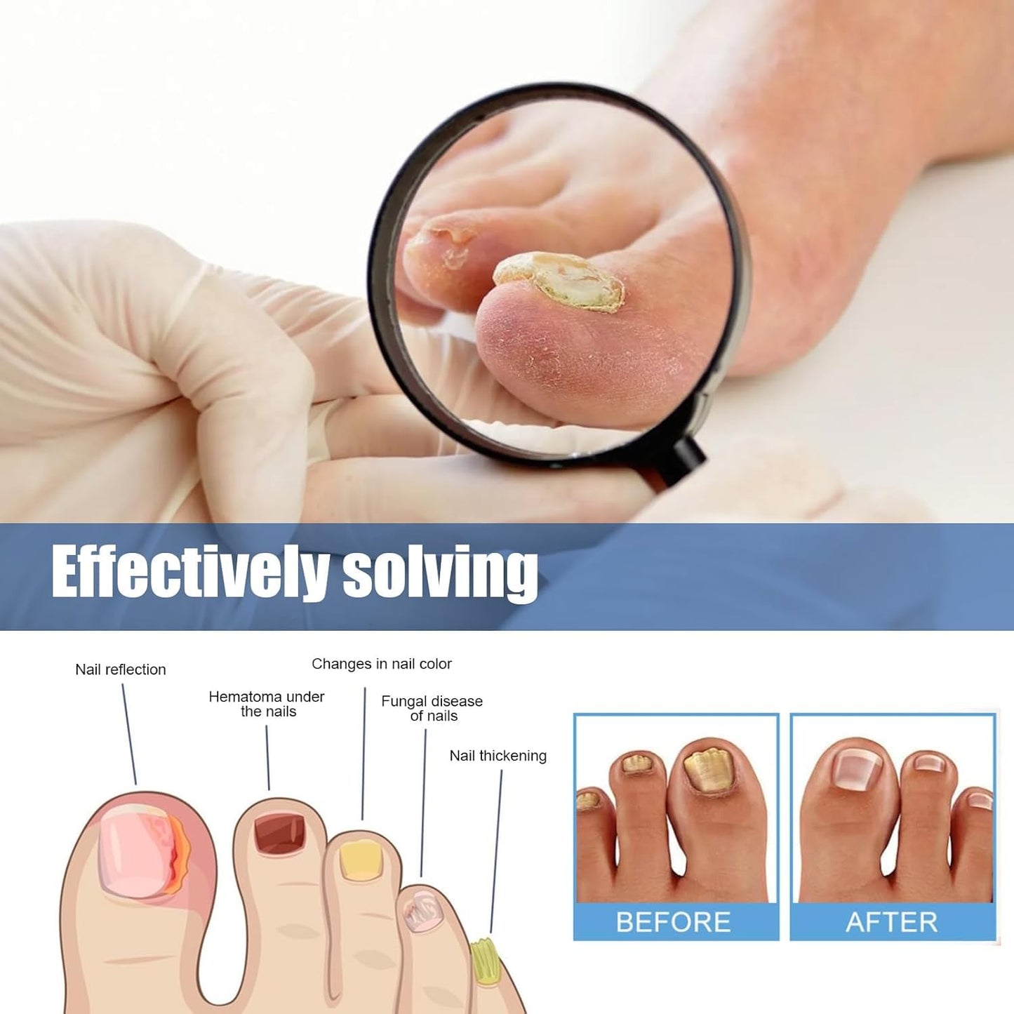 Toenail Fungus Treatment Extra Strength, 60Pcs Fungal Nail Patches for Damaged Nails, 8-Hour Nighttime Renewal & Natural Hydrogel Nail Repair Patches