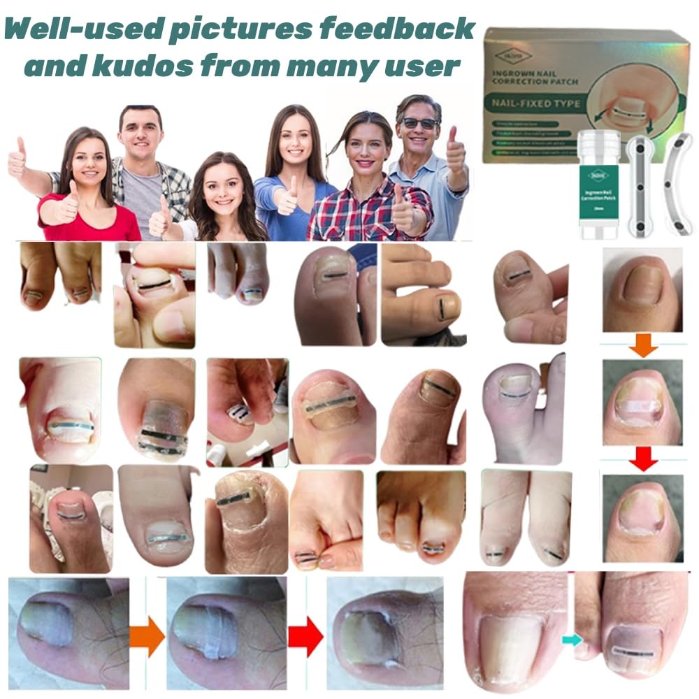 Ingrown Toenail Removal Kit | Titanium Alloy Ingrown Toenail Treatment | Pedicure Tools for Feet, Nail Tools Specially Designed for Curved Nail Repair and Ingrown Toenail Corrector (0.67/0.79in)