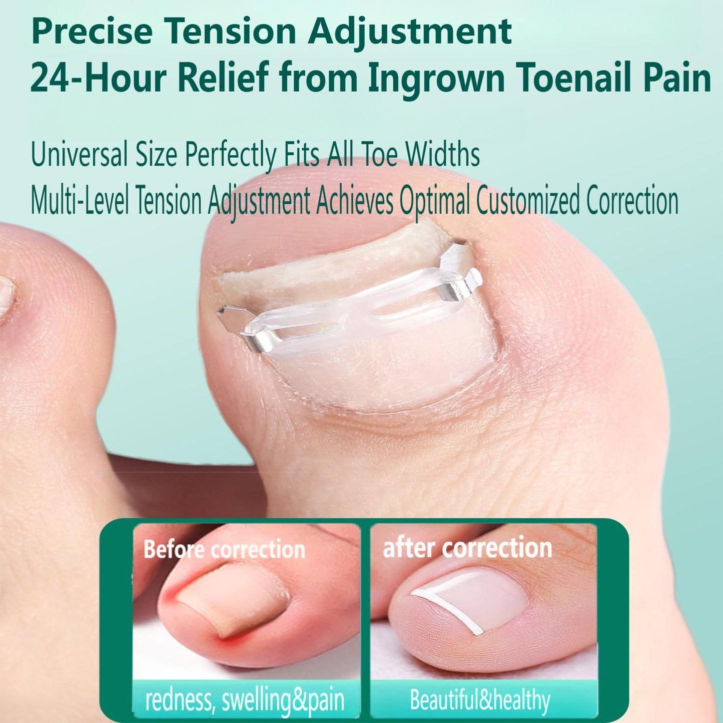 Zanchara Ingrown Toenail Corrector Kit for Men Women - Ingrown Nail Tool - 2 Stainless Steel Clips- Curved Nail Strips & Toe Pads for Embedded/Curled Nails