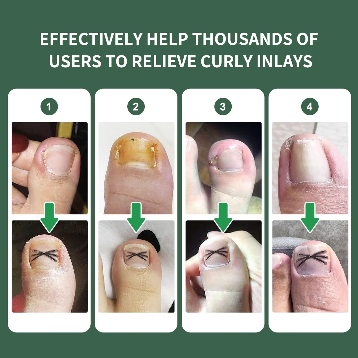 Titanium Alloy Ingrown Toenail Treatment 3X Stronger Pulling Force, Nail Tools and Ingrown Toenail Repair Kit for Curved & Thick Nails, Professional Foot Care Solution for Men & Women (0.63/0.67 in)