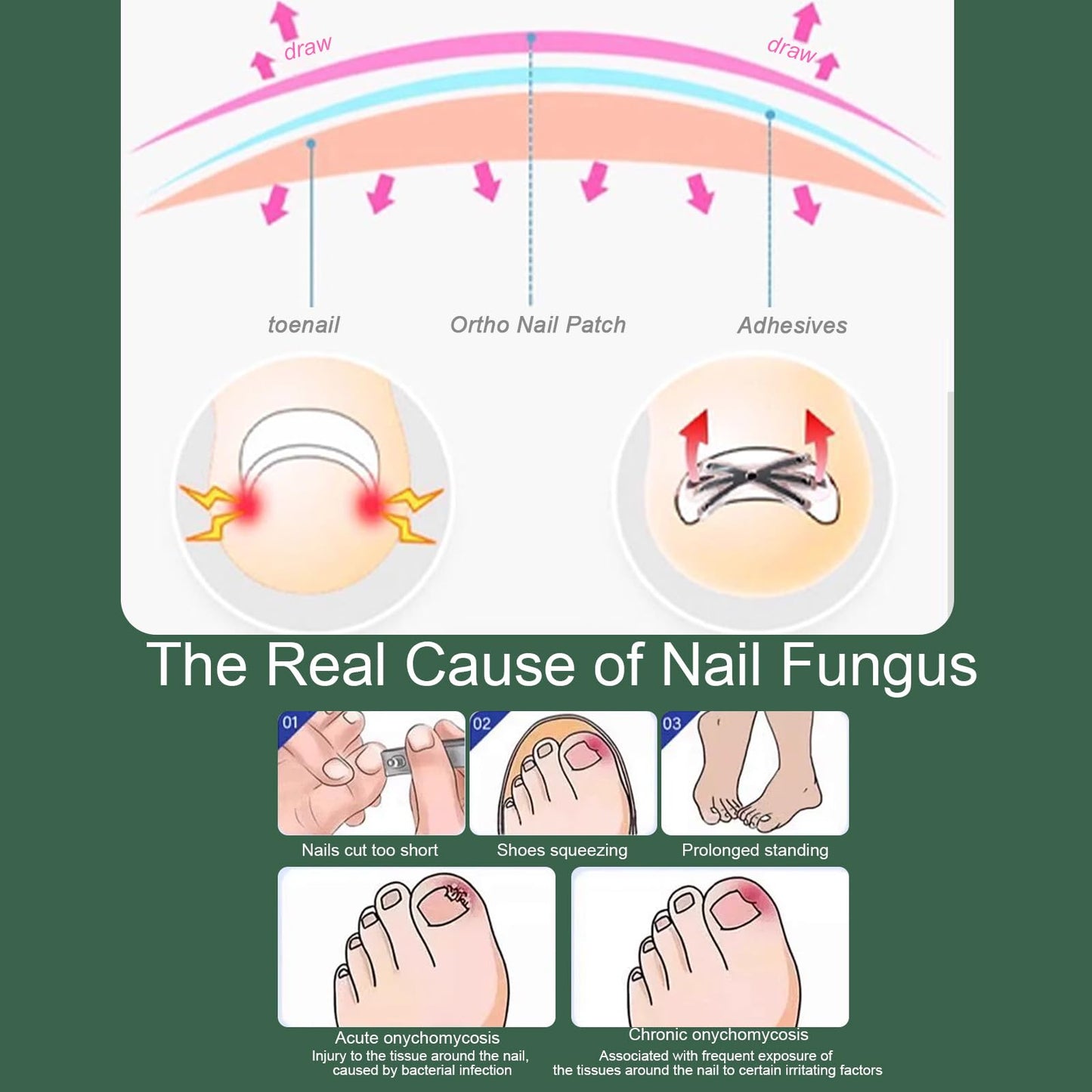 Titanium Alloy Ingrown Toenail Treatment 3X Stronger Pulling Force, Nail Tools and Ingrown Toenail Repair Kit for Curved & Thick Nails, Professional Foot Care Solution for Men & Women (0.63/0.67 in)