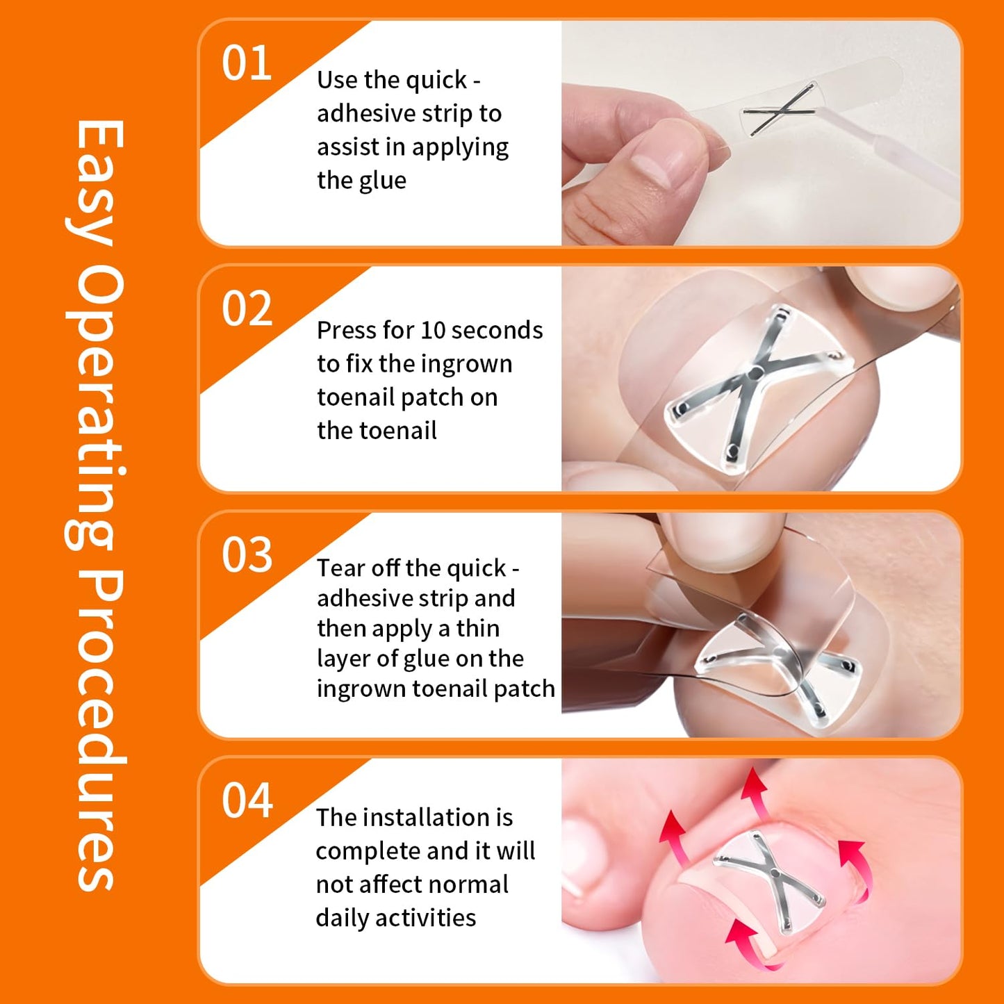 X-Shaped Upgrade Titanium Alloy Ingrown Toenail Corrector,At Home Ingrown Toenail Treatment for Man and Women,Ingrown Toenail Removal Kit,Curved Toenail Straightener (Large Size)