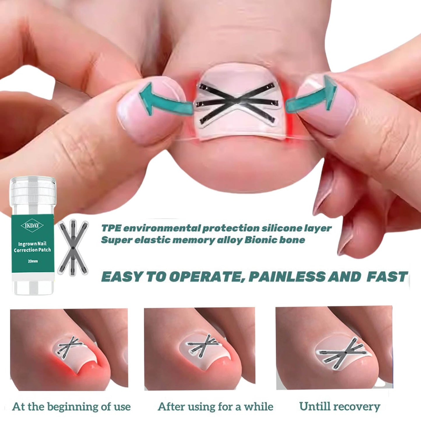 Ingrown Toenail Treatment & Removal Kit (New 6X Tension) at Home Treatment for Toenails,Titanium Alloy Ingrown Toenail Corrector, Nail Tools for Curved Nail Repair for Men Woman (0.67/0.79in)