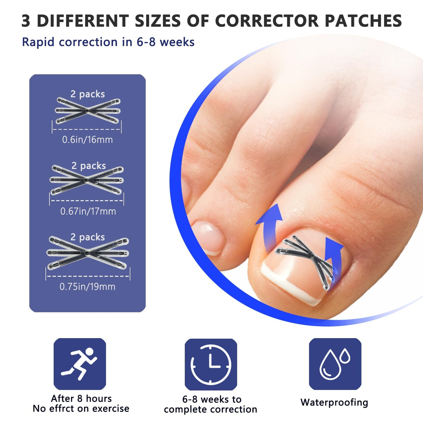 Upgraded MI-shaped Design Titanium Alloy Ingrown Toenail Corrector for Quick Pain Relief, Ingrown Toenail Treatment and Removal Tool Kit for Effective Curved Nail Repair, 6pcs