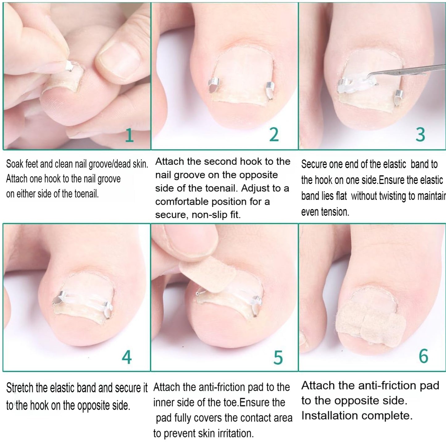 Zanchara Ingrown Toenail Corrector Kit for Men Women - Ingrown Nail Tool - 2 Stainless Steel Clips- Curved Nail Strips & Toe Pads for Embedded/Curled Nails